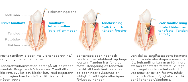 Tandlossning - olika stadier